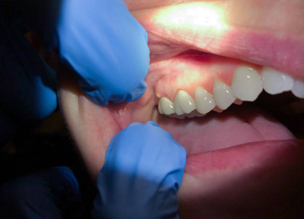 Best Emergency Dental Extractions in Weatherly, PA